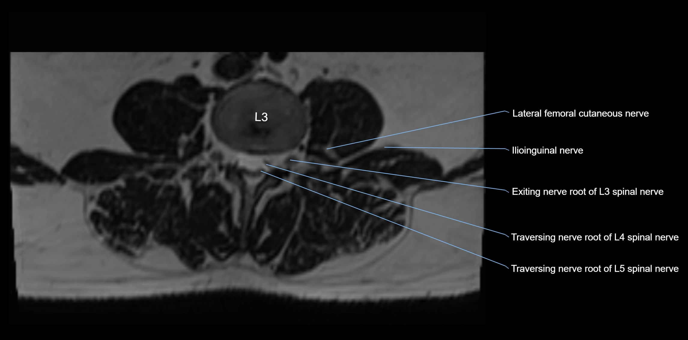 MR lumbosacral plexus axial cross sectional anatomy 3T  radiology  image-img-1008001-00026.webp